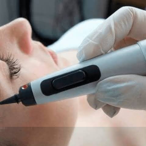 CryoPen behandeling in het gezicht bij Dermatique Marjo